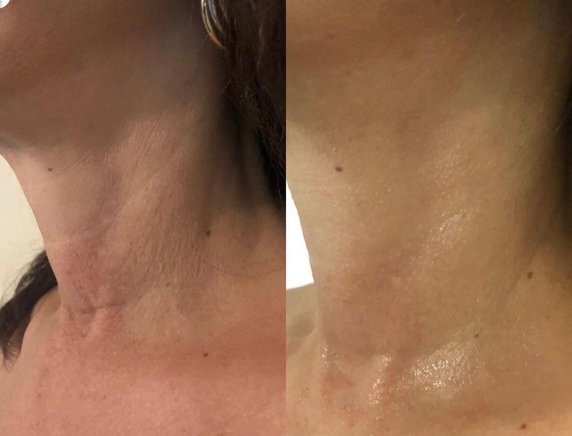 Before and after: neck tightening and texture