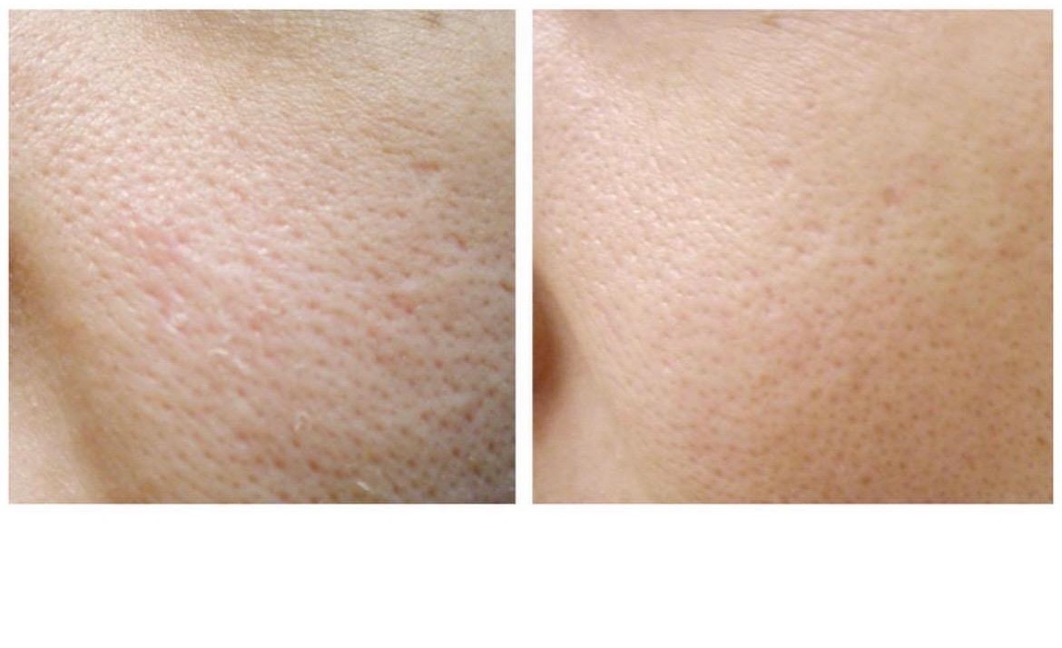 Before and after: cheek pores and texture