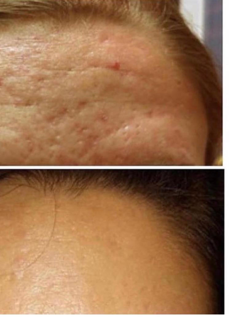Before and after: forehead acne scarring